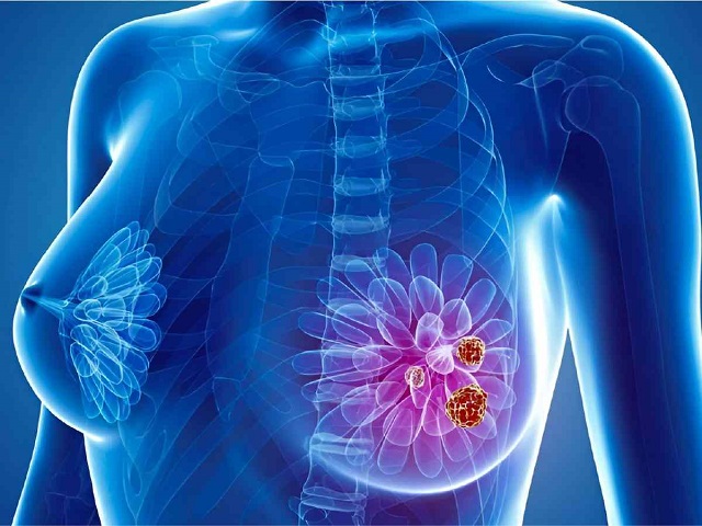 Pacientes con cáncer de mama metastásico pueden mejorar su expectativa de vida con medicamentos innovadores