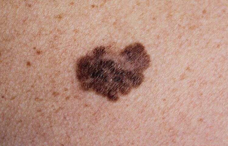 Cáncer de piel:Tener cinco o más quemaduras solares duplica el riesgo de un melanoma